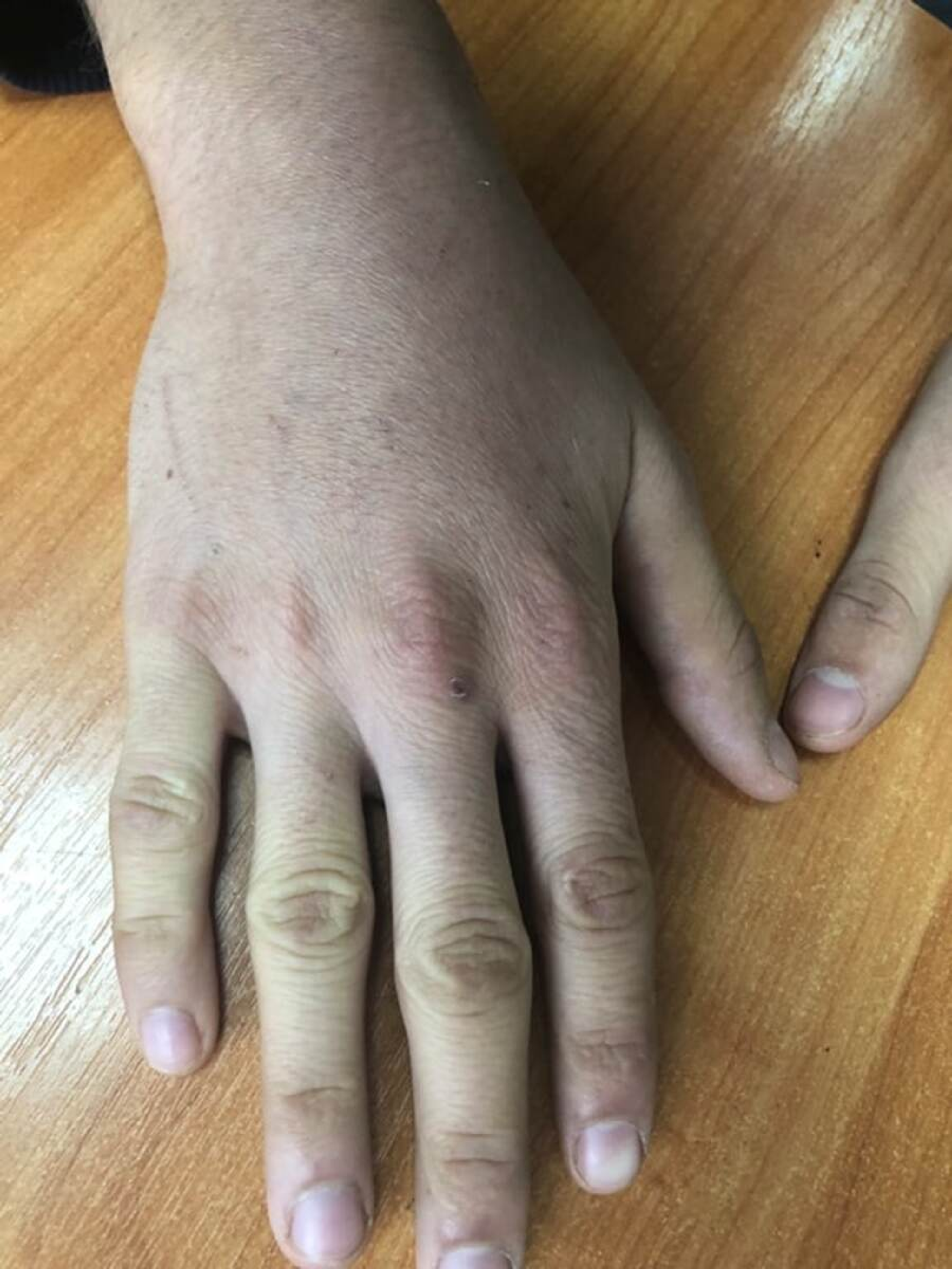 Cureus | Case Reports of Cat Scratch Disease in Patient With Unjustified Surgical Intervention | Article Cureus | Case Reports of Cat Scratch Disease in Patient With Unjustified Surgical Intervention | Article