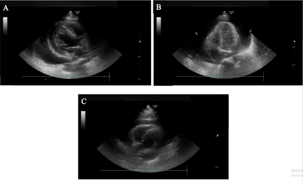 Surgical Management of Non-Cardiac Pericardial Effusion: Etiology, Diagnosis, and Early Outcomes