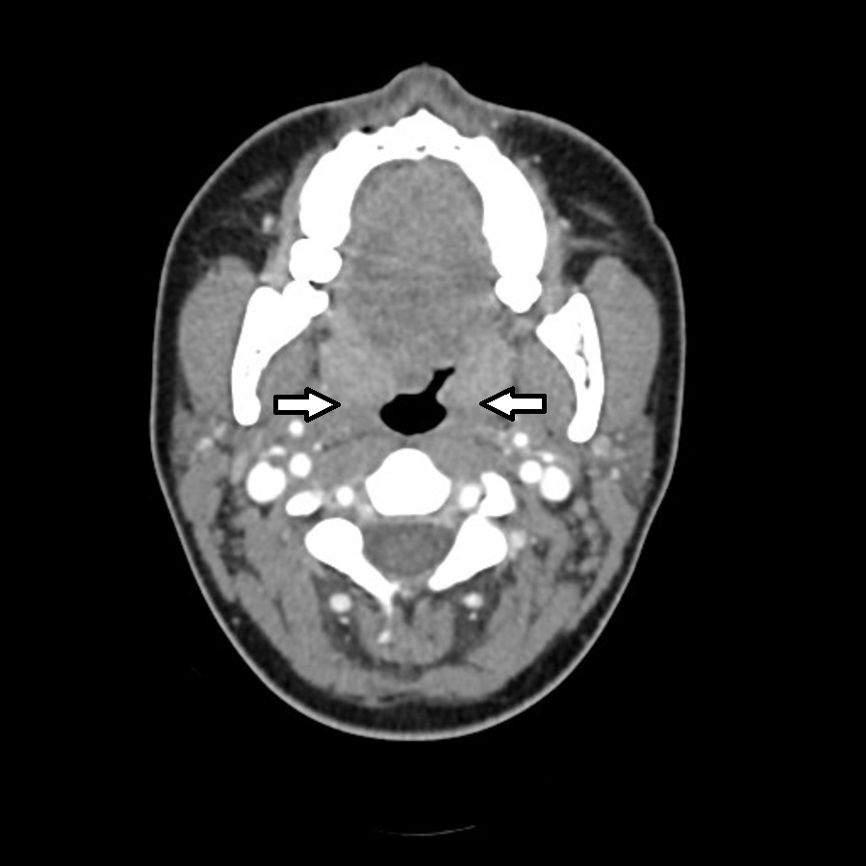 Cureus Lemierre's Syndrome A Case Report
