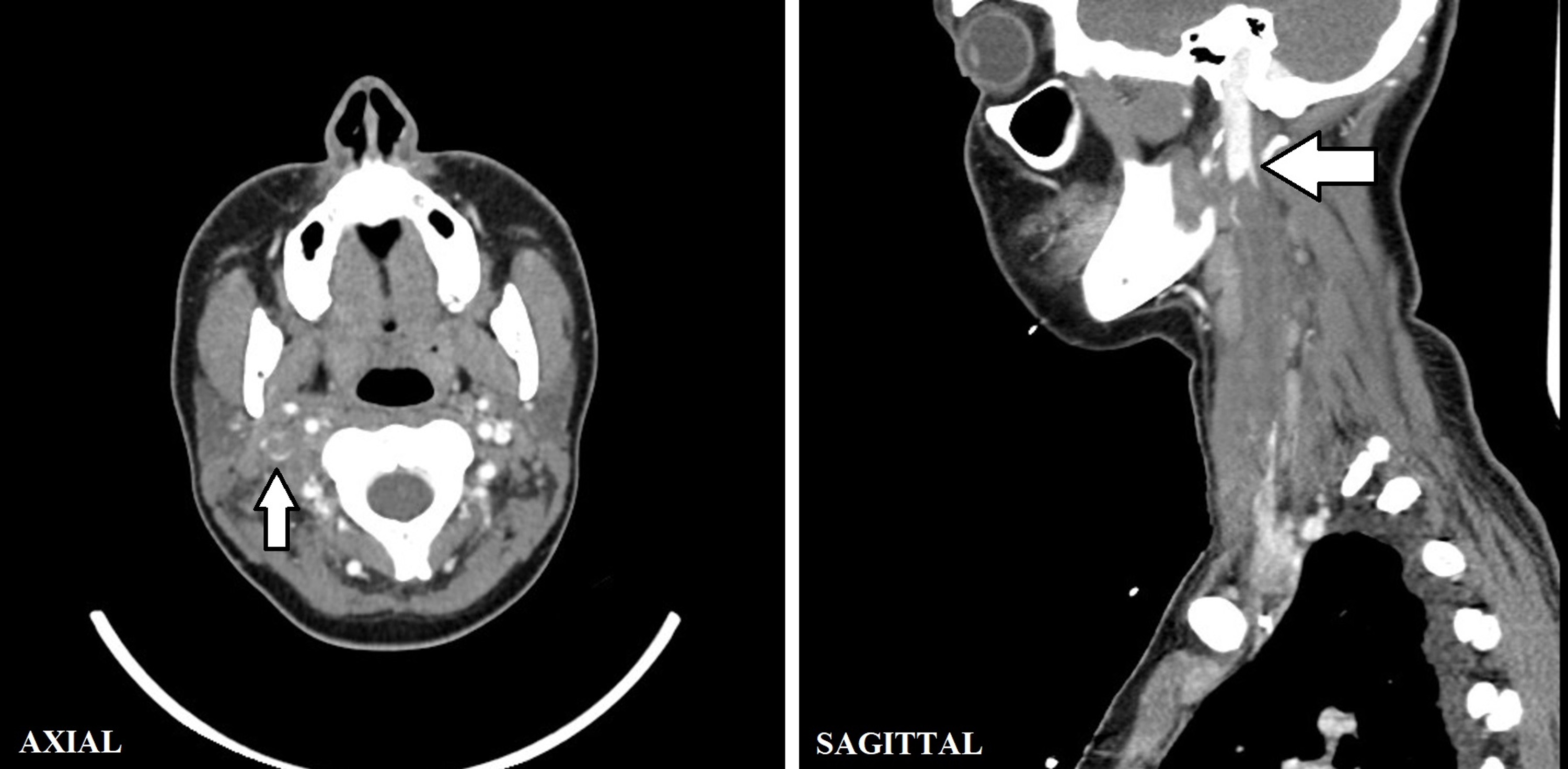 Cureus | Lemierre's Syndrome: A Case Report