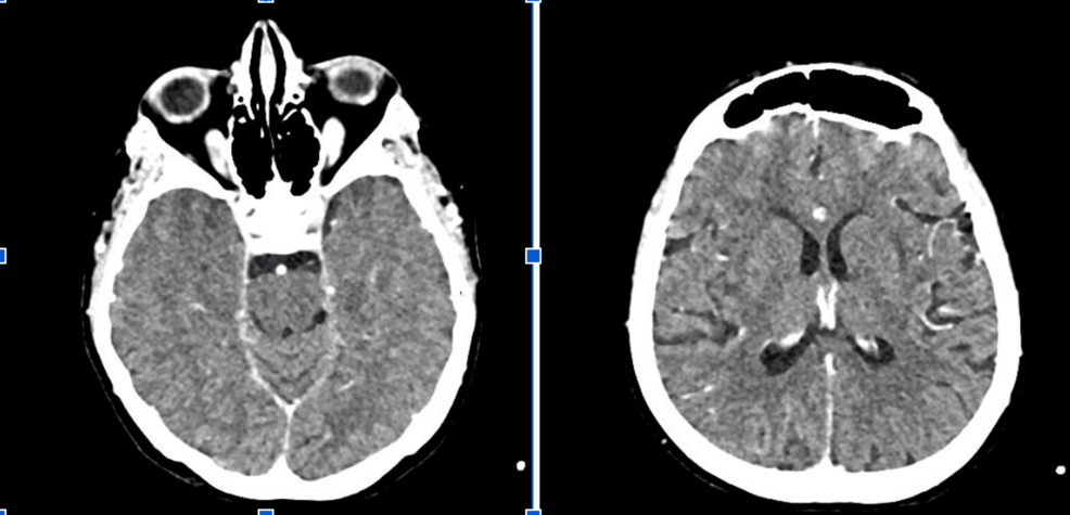 PRES in an Anuric Patient With WT1 Mutation and Renal Graft Failure