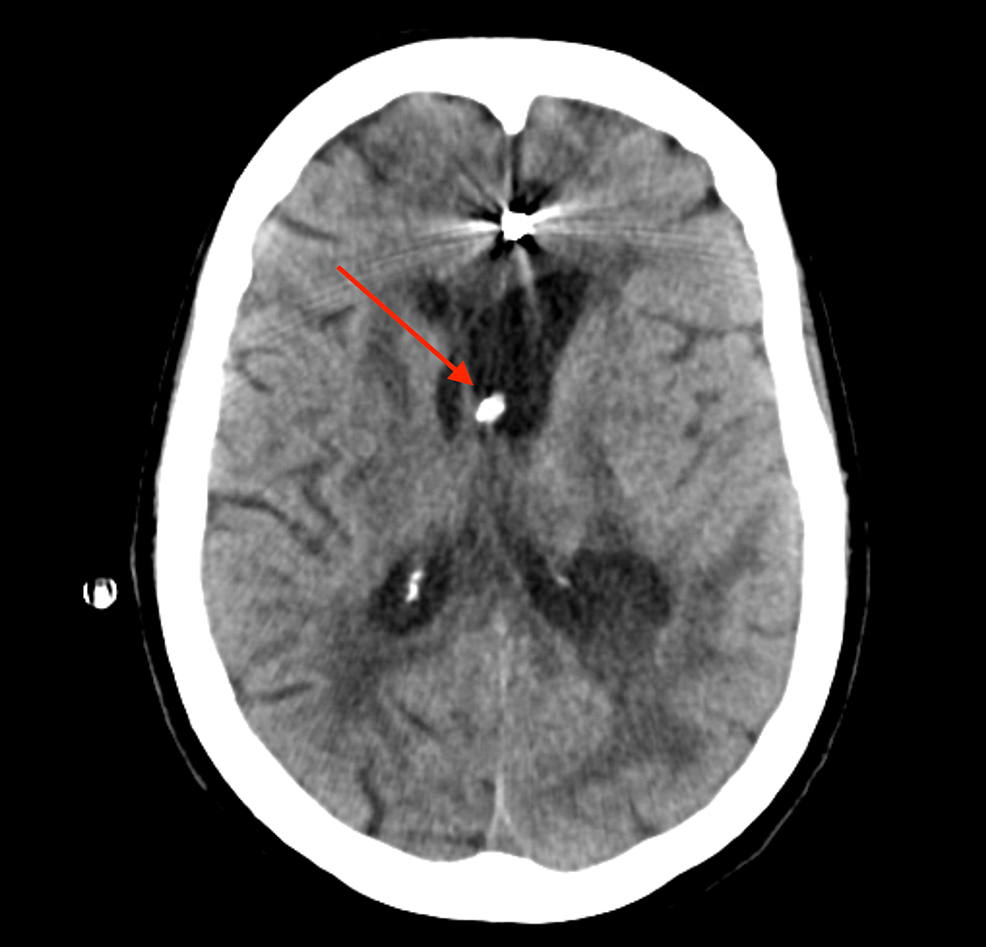 Cureus Drainage, Irrigation, and Fibrinolytic Therapy (DRIFT) for