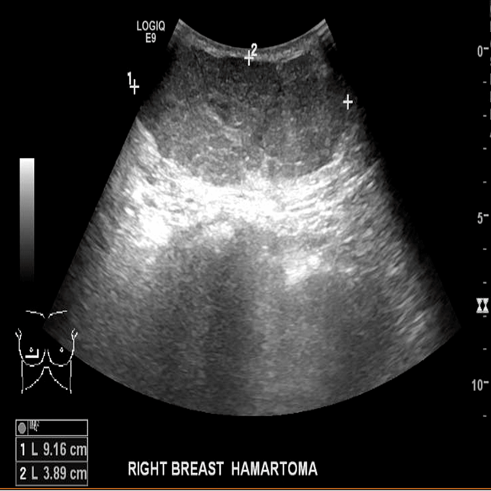 Cureus | Giant Lactating Adenoma With Fibroadenomated Changes | Article