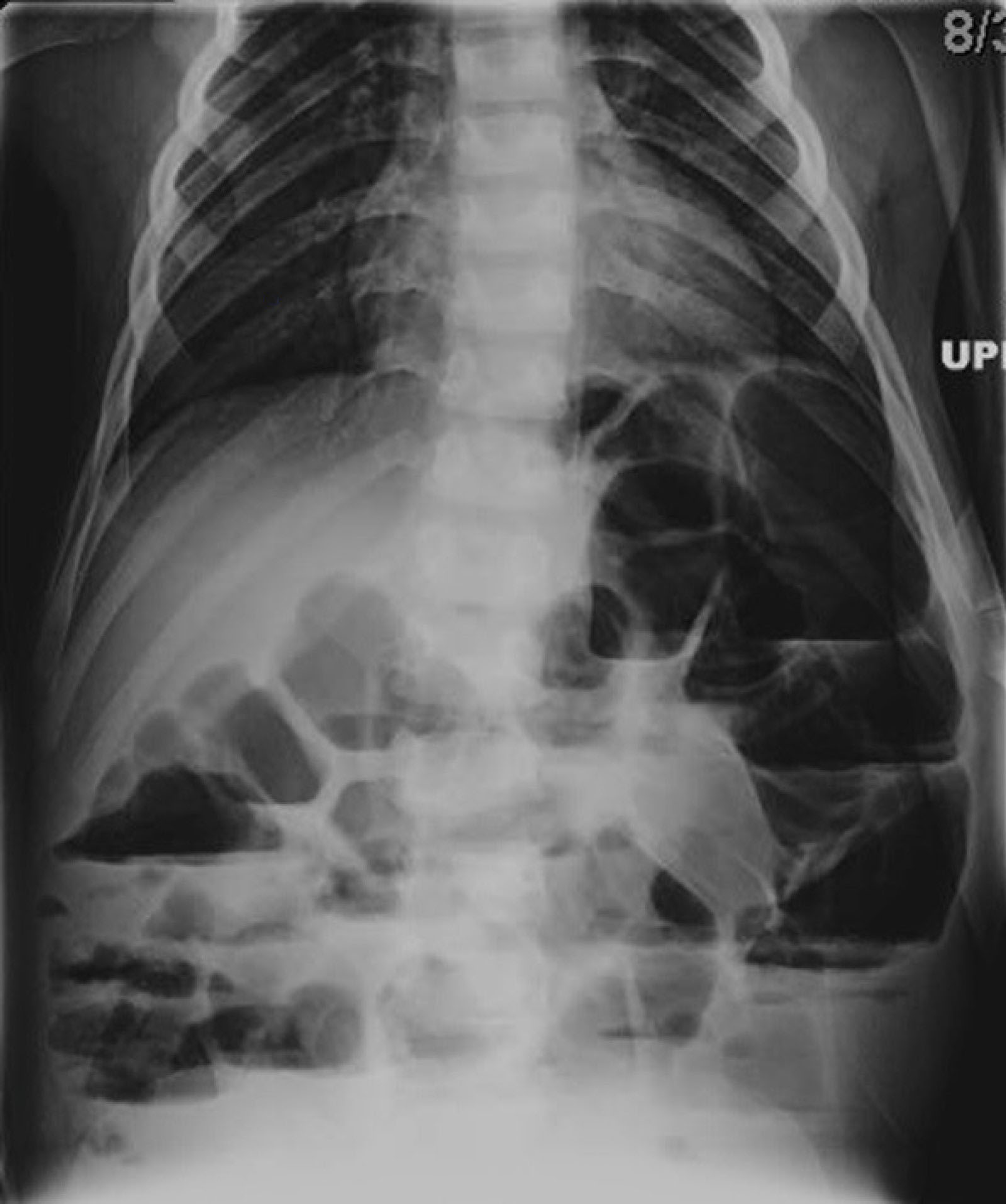 Cureus Stretched to the Max The Successful Medical Management of