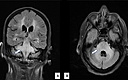 Cureus | Extensive Brainstem Posterior Reversible Encephalopathy ...