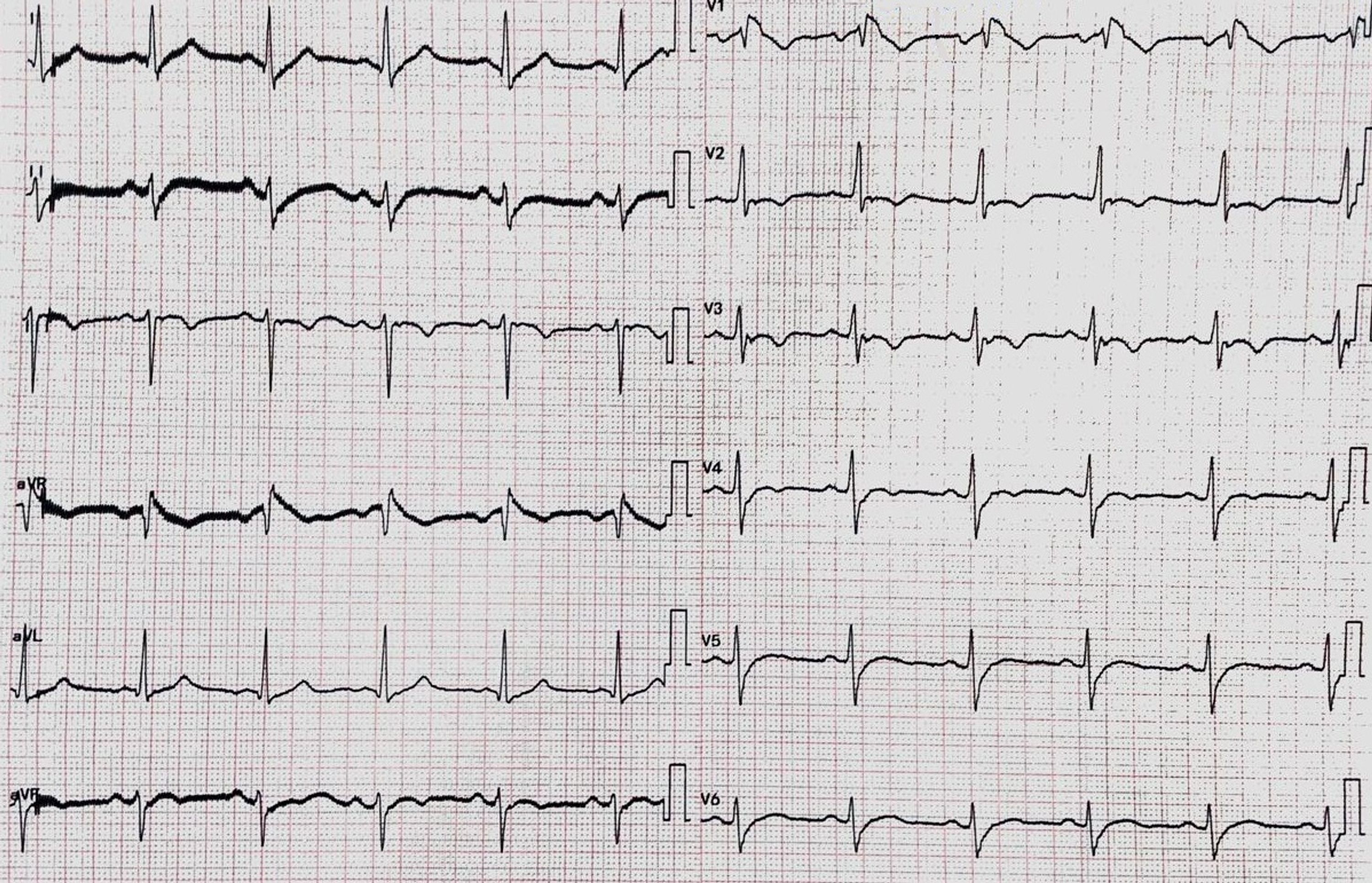 arrhythmogenic right ventricular cardiomyopathy histology