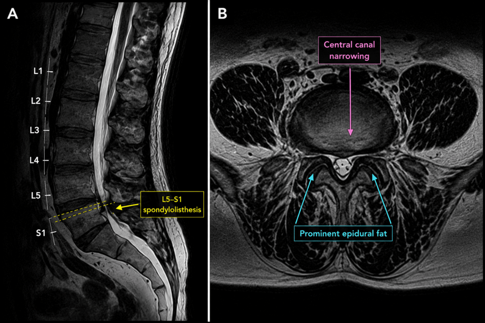 Lumbar-magnetic-resonance-imaging-findings.