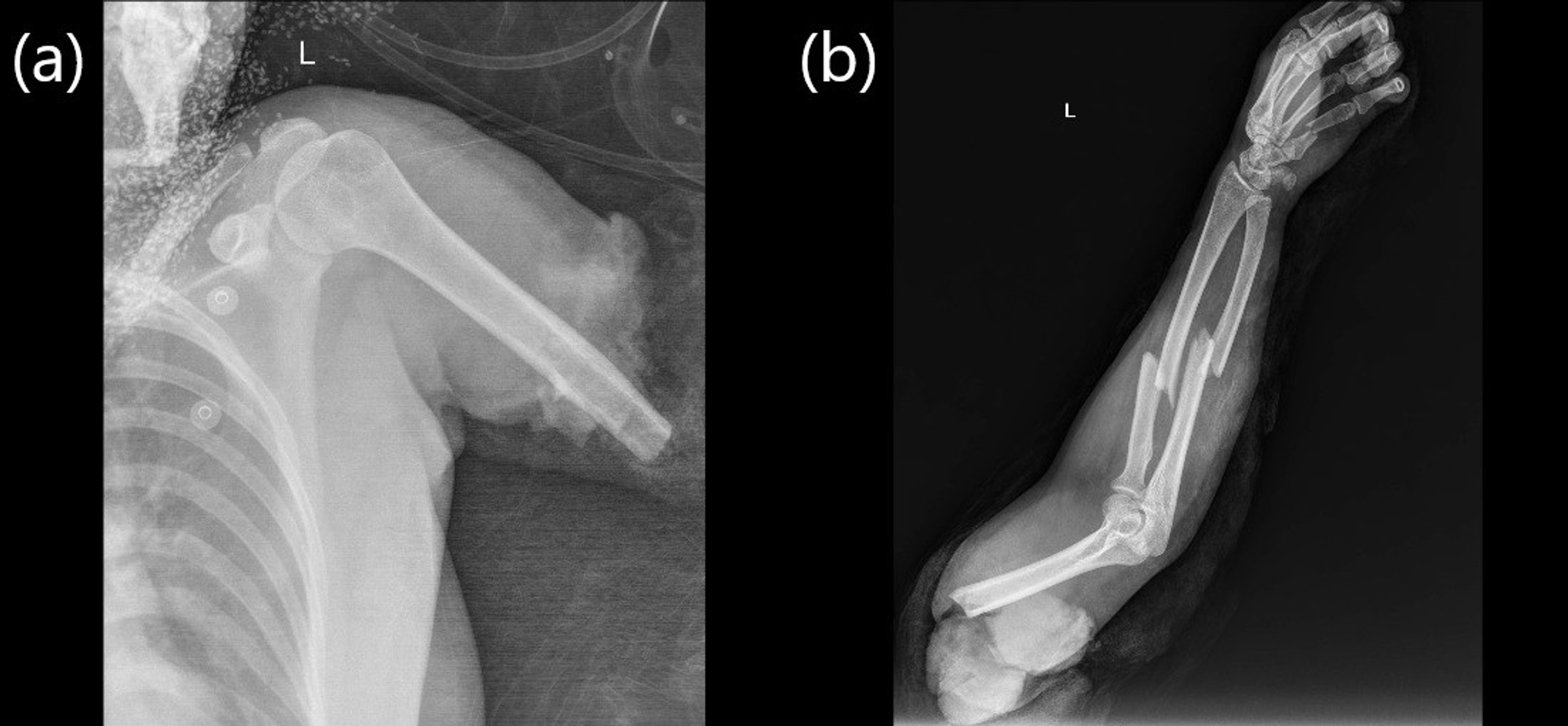 Cureus | Failure Of Major Upper Extremity Replantation Due To COVID-19 ...