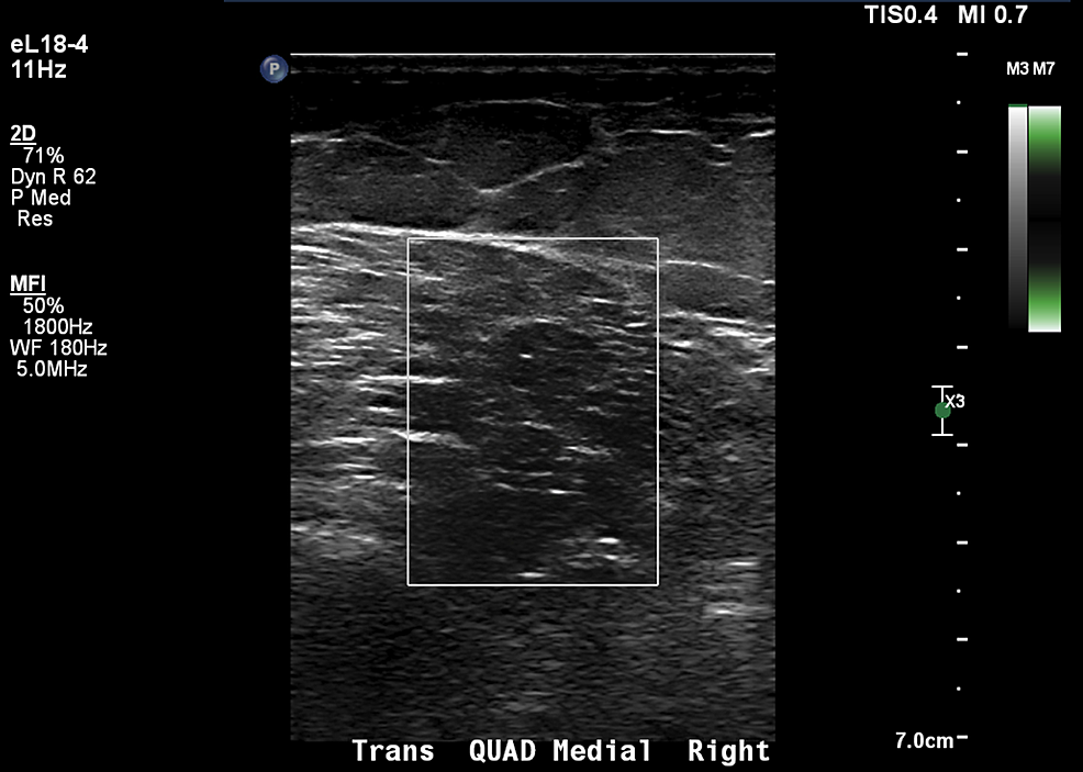 Cureus | Atypical Power Doppler Ultrasound Findings in Juvenile ...