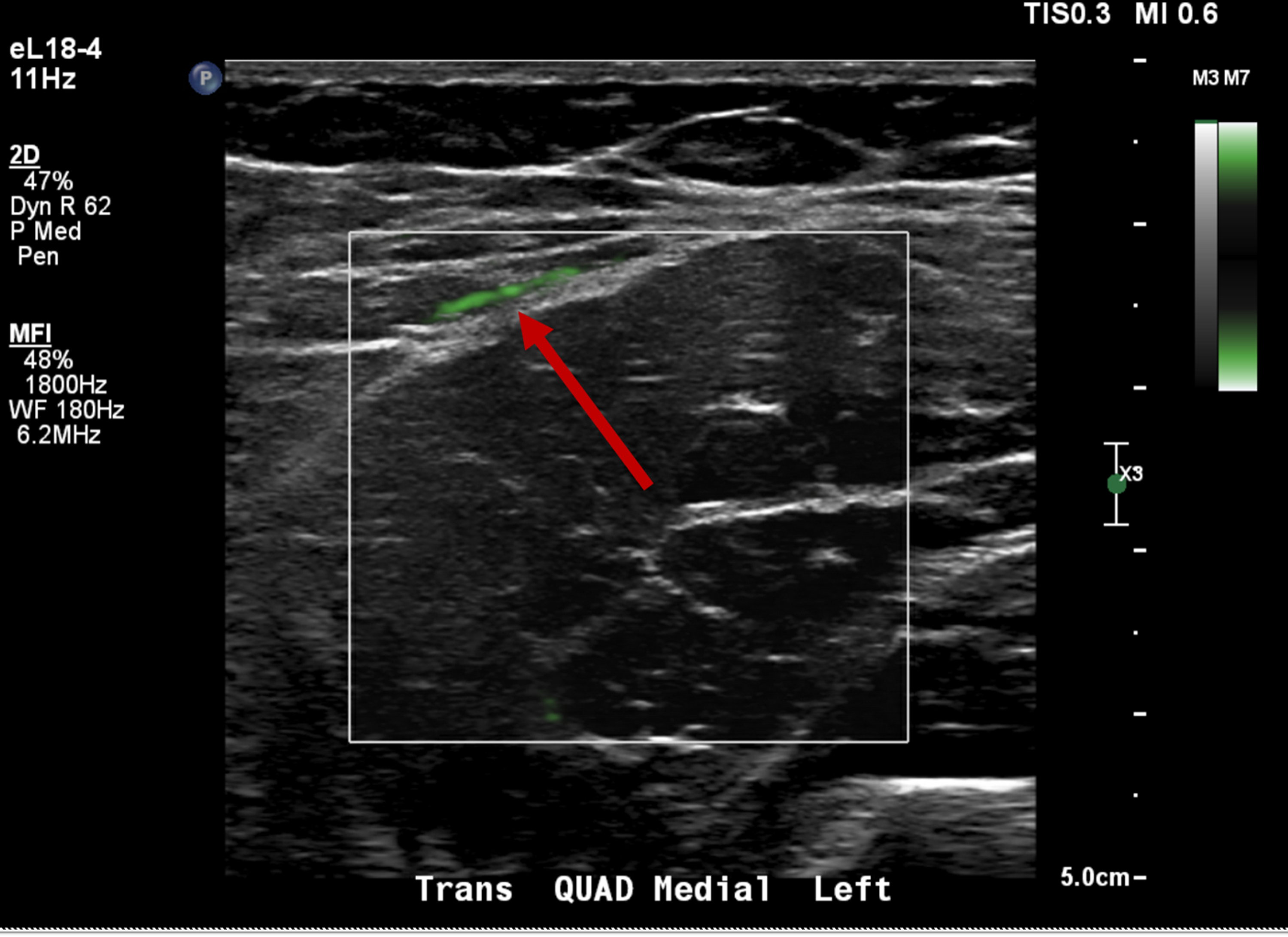 Cureus | Atypical Power Doppler Ultrasound Findings in Juvenile ...