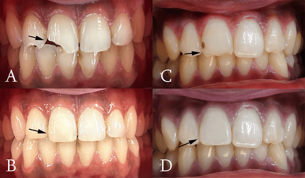 Clinical Color Match and Marginal Discoloration of a Universal Shade Composite Versus a Multi-shade Nanohybrid Composite in Anterior Teeth