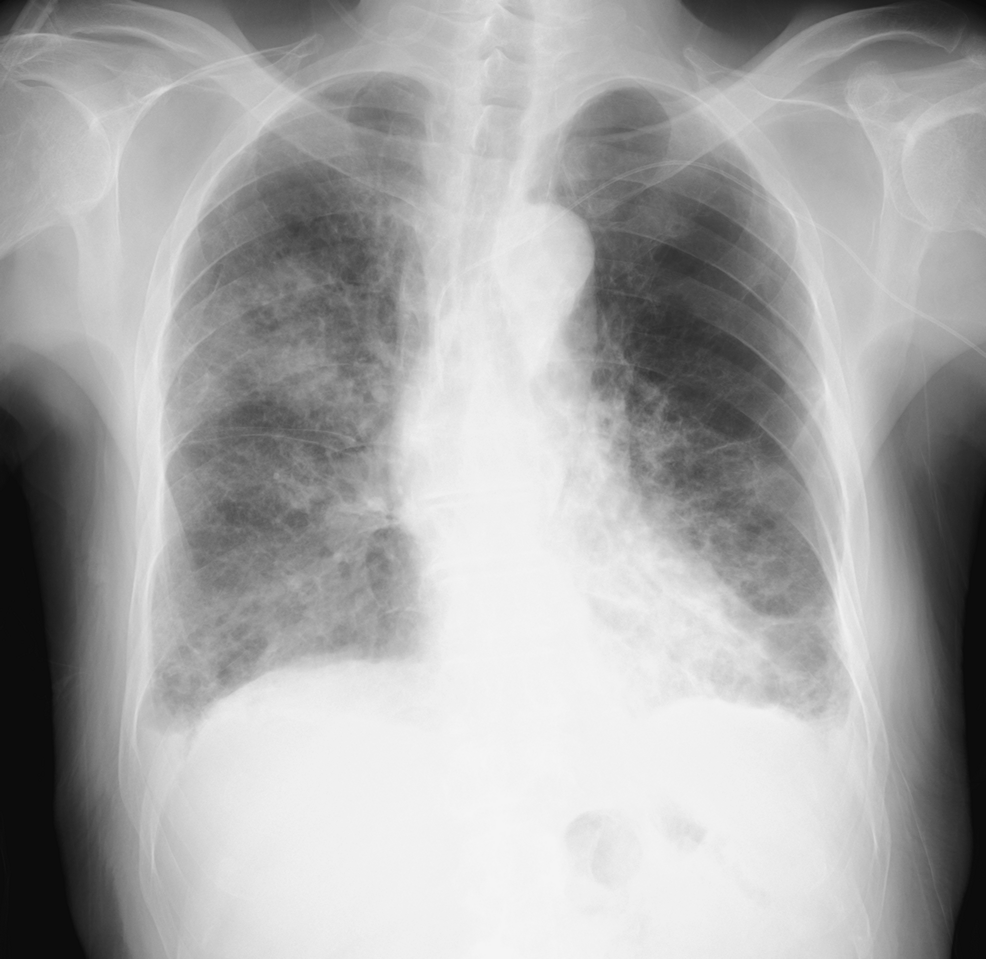 Chest-radiograph-obtained-during-postoperative-pneumonia-after-total-gastrectomy.
