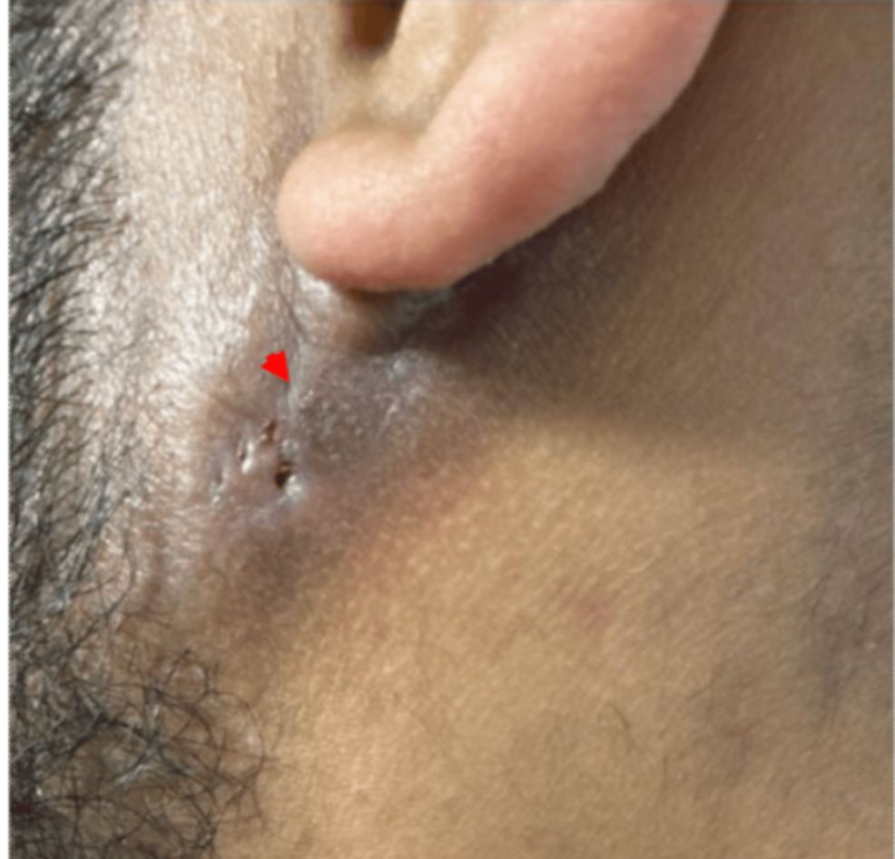 Disseminated Tuberculosis with Rare Manifestations in a Young Immunocompetent Male Patient