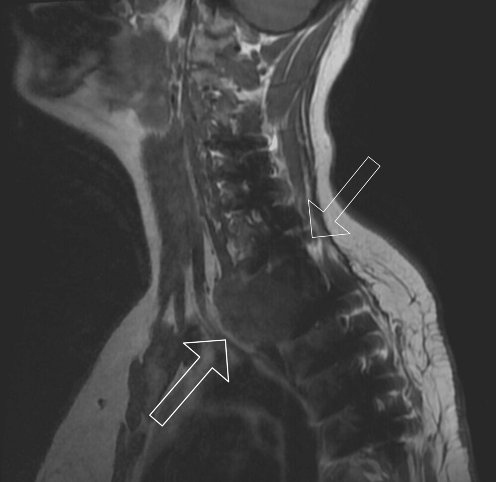 Cervical-spine-MRI.