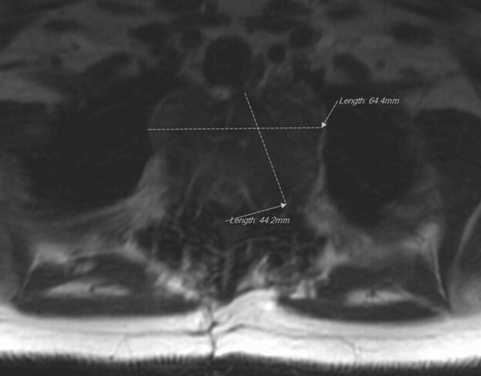 Thoracic-spine-MRI.