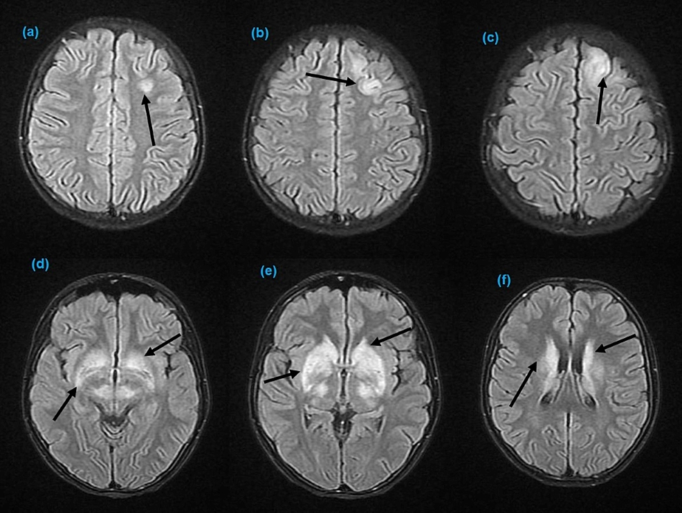 Axial-FLAIR-T-2-weighted-images-of--the-brain.