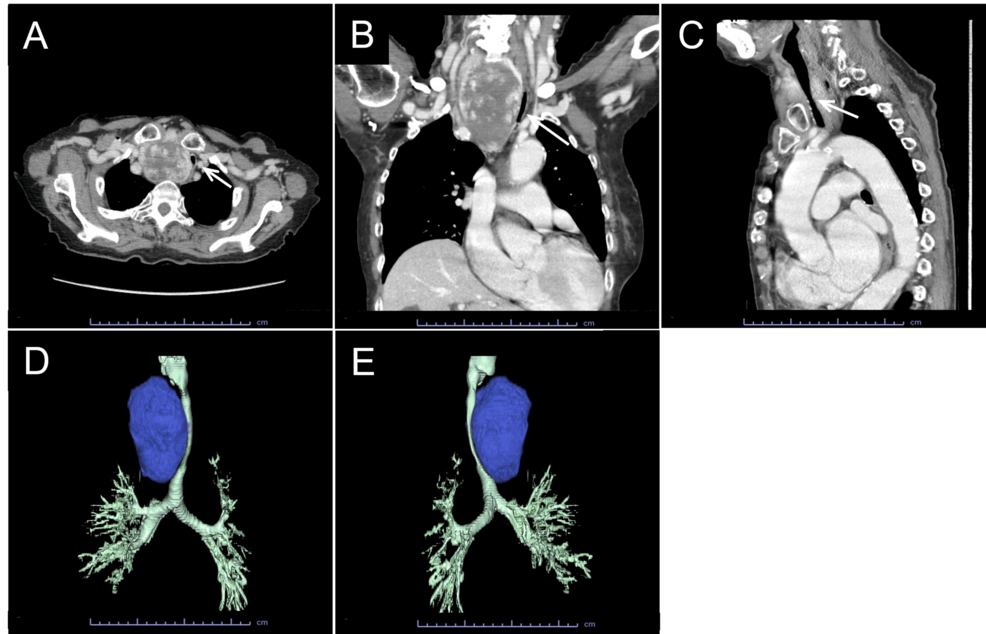 CT-and-three-dimensional-reconstruction-of-a-massive-goiter-causing-severe-tracheal-stenosis