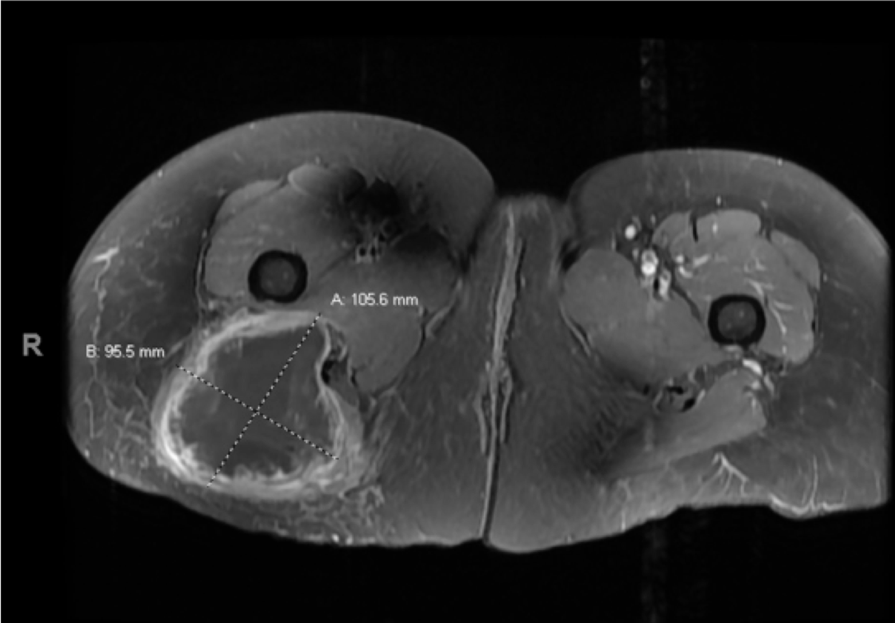 Lipoma Buttock