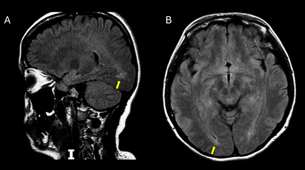 ABCD1-Related Disease Presenting as an Upper Motor Neuron-Predominant Amyotrophic Lateral Sclerosis Mimic in a Colombian Female Heterozygote: A Case Report