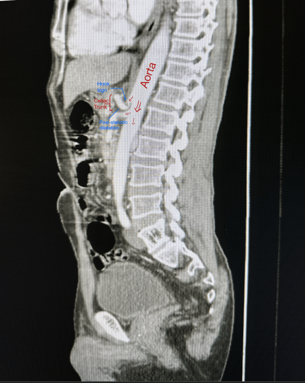 Median Arcuate Ligament Syndrome Beyond the Classic Demographic: Celiac Artery Compression in a 62-Year-Old Man With Cardiovascular Risk Factors