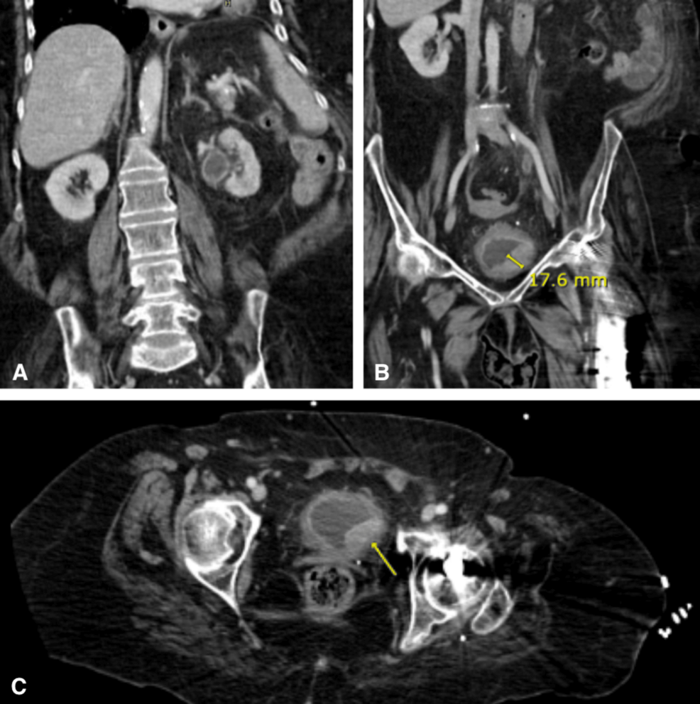 iv glutathione following ct scan Primary Diffuse Large B-cell Lymphoma of the Urinary Bladder: A Case Report and Narrative Review of Treatment Modalities and Clinical Outcomes Alpha Lipoic Acid Main Energy-Vitality NEXUS PHARMA:(BUY 1) NEXUS PHARMA GLUTANEX TABLETS