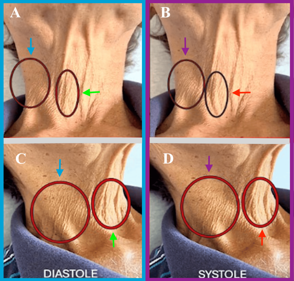 Forgotten but Striking: Complete Tricuspid Valve Degeneration Unmasked by Lancisi’s Sign