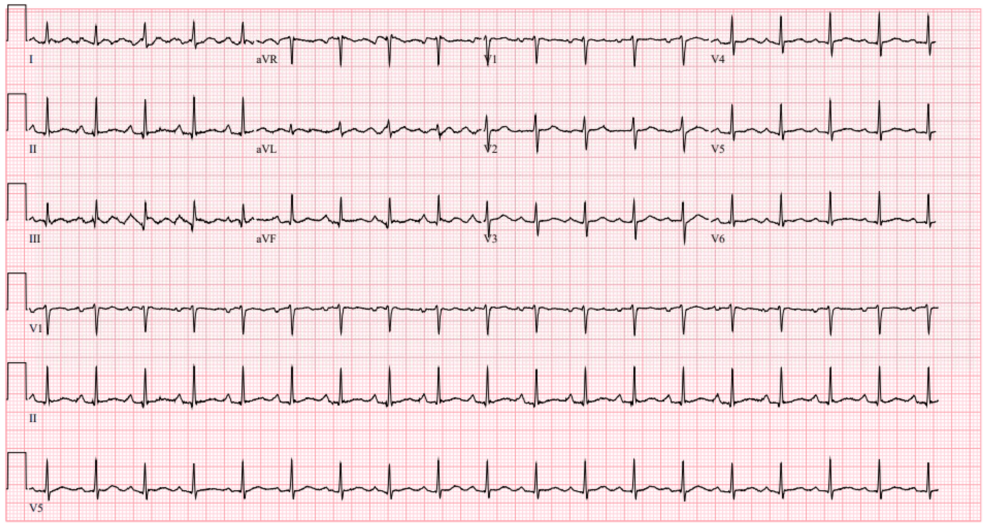 Pseudomonas Endocarditis with Septic Shock and Stroke During PD-L1 Inhibitor Therapy
