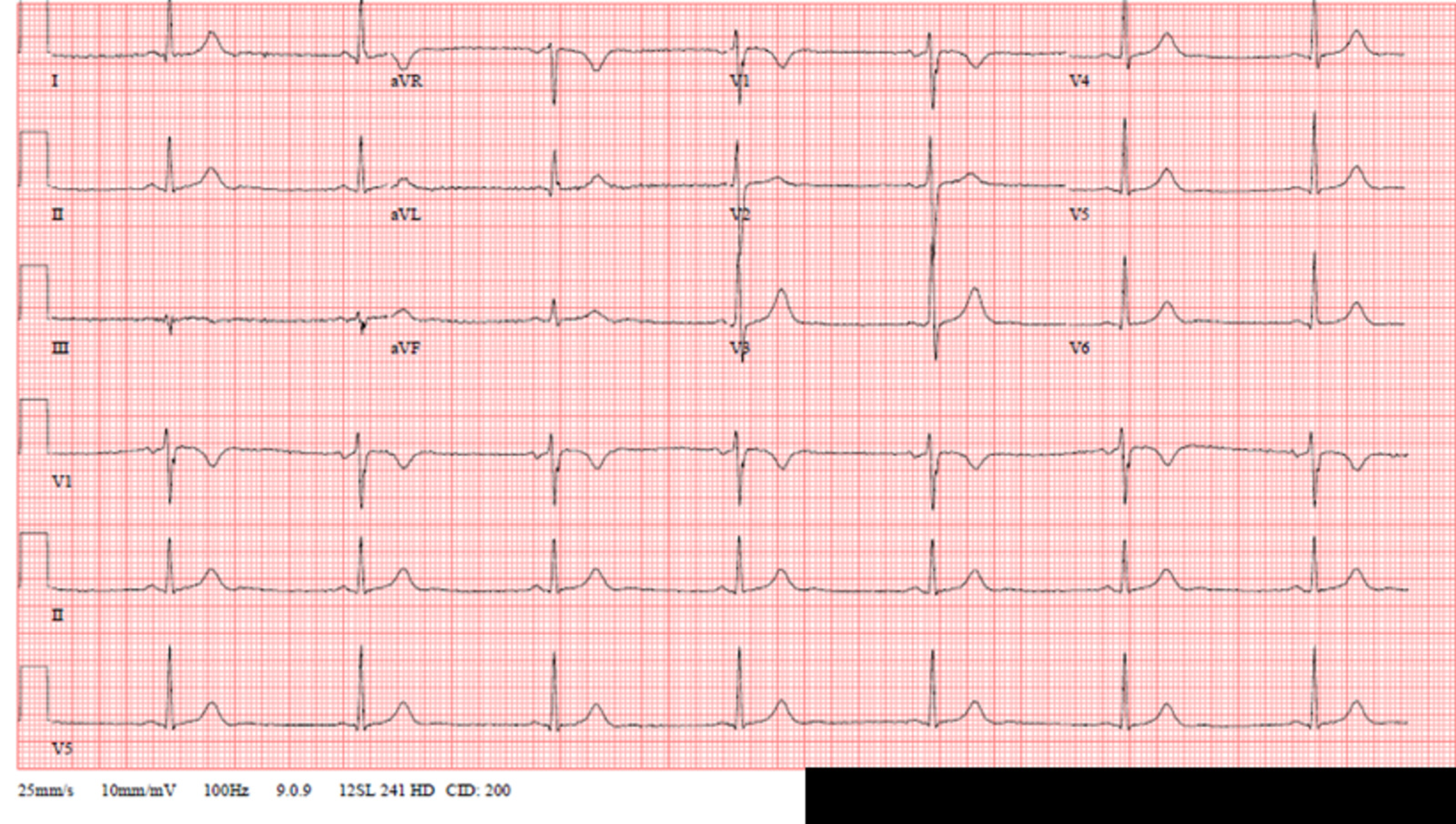 Cureus Steroid Induced Sinus Bradycardia