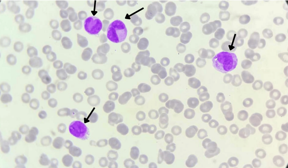 Acute Promyelocytic Leukemia and Type 2 Diabetes in a Child: A Rare Case Report