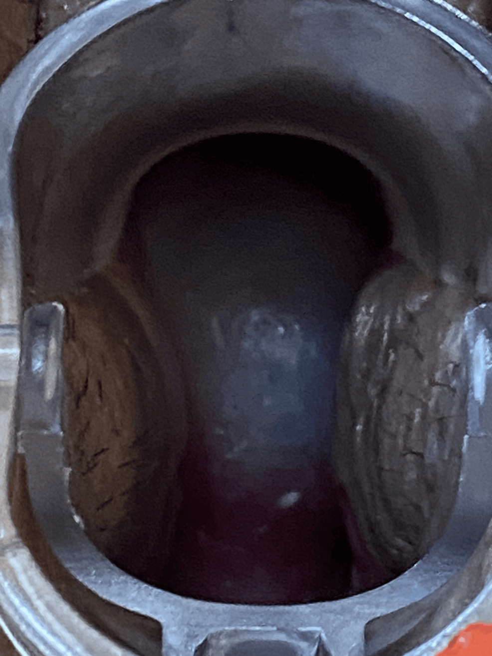 A Giant Nabothian Cyst Associated With Secondary Infertility: A