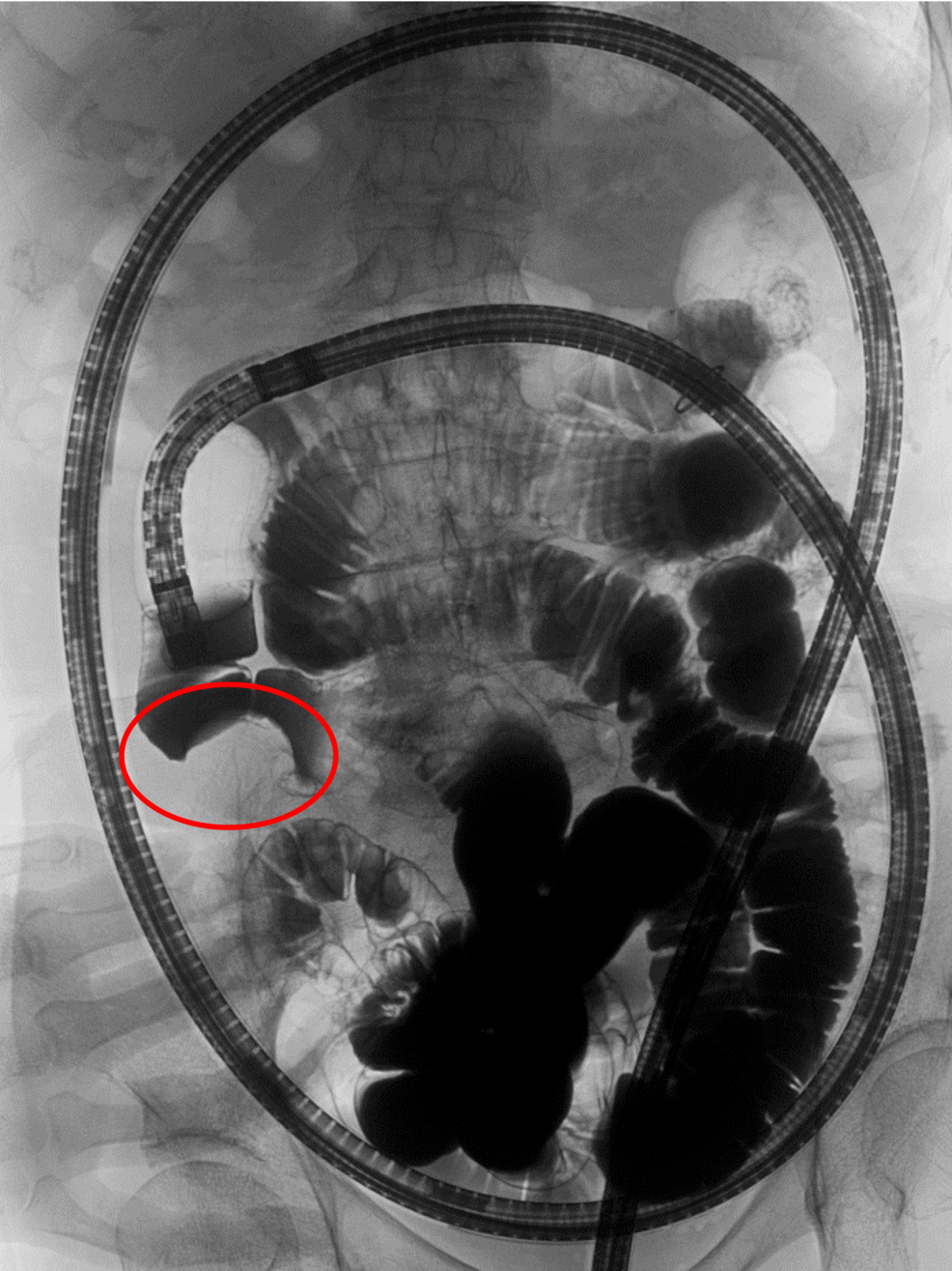 Recurrent Severe Iron Deficiency Anemia Caused by a Small Bowel Gastrointestinal Stromal Tumor in a 90-Year-Old Woman: A Case Report