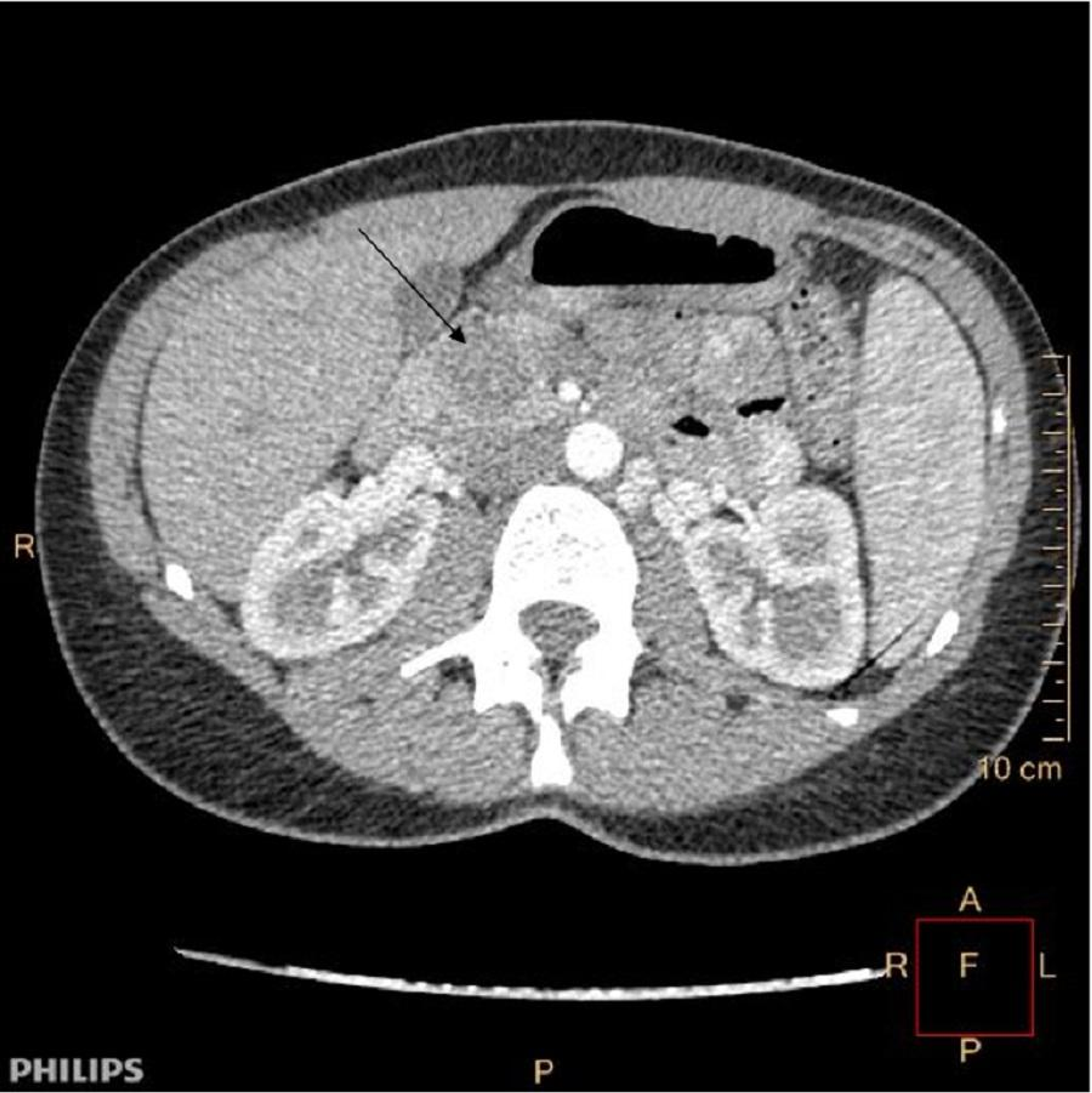 Cureus Solid Pseudopapillary Tumor Of The Pancreas In A 25 Year Old Female A Rare Entity Of Pancreatic Tumors