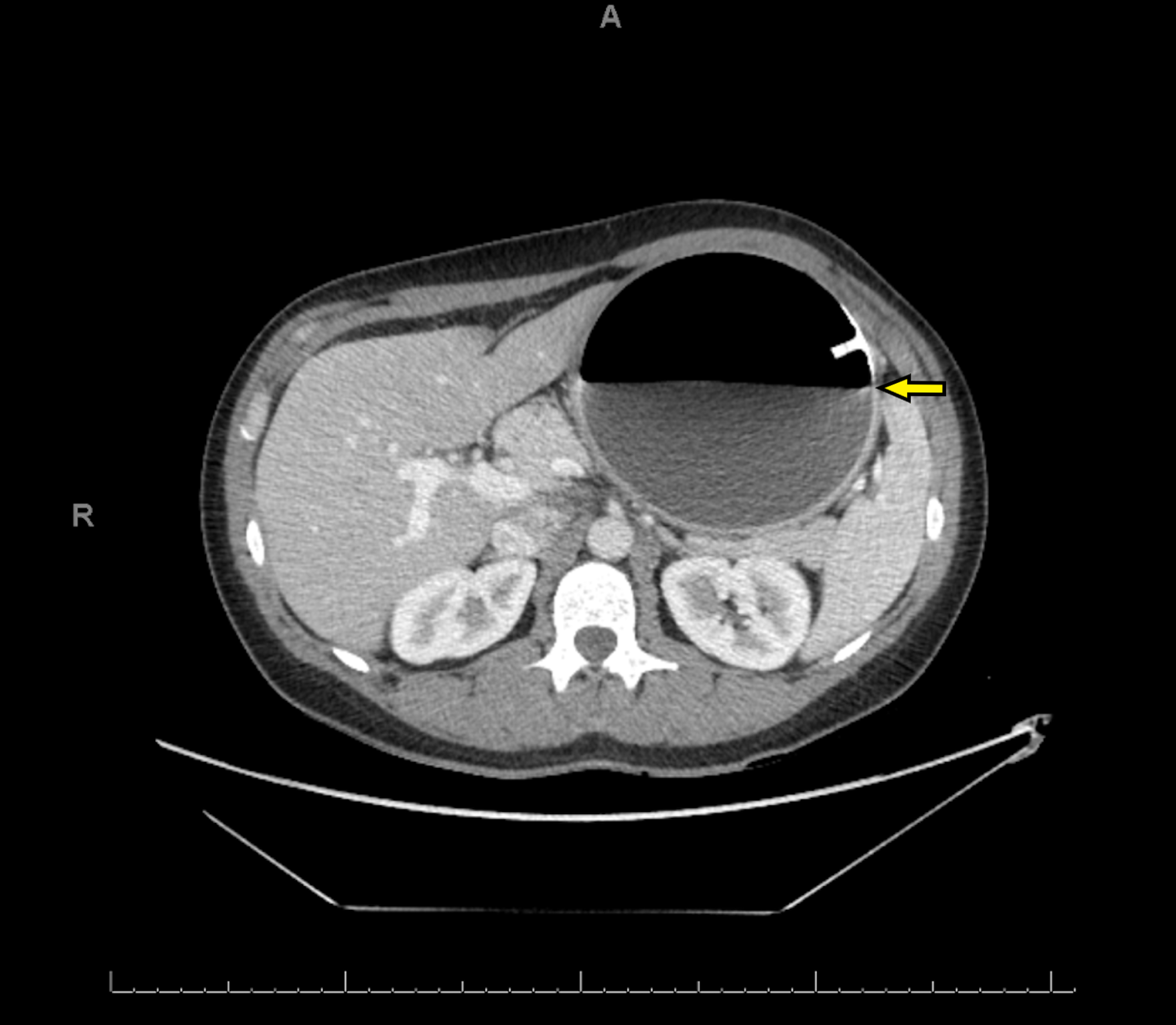 Cureus Spontaneous Hyperinflation of an Intragastric Balloon Causing