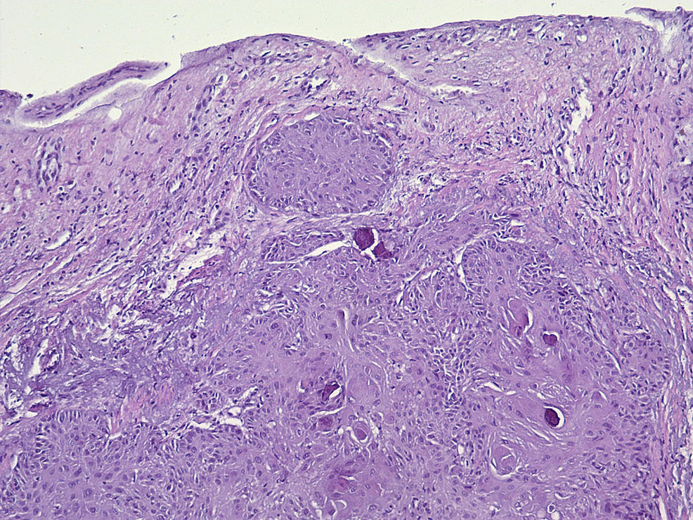 Cureus | Squamous Cell Carcinoma Of The Nail, An Underdiagnosed And ...