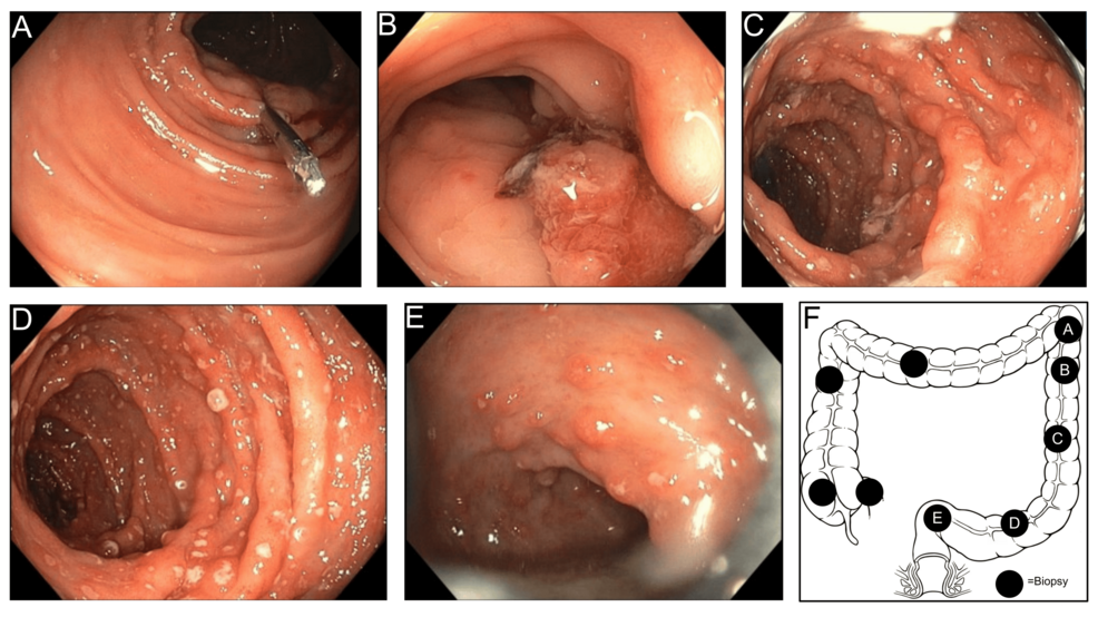 Utility of the Inflammatory Bowel Disease Serology, Genetics, and Inflammation (IBD-SGI) Panel in the Evaluation of Atypical Ulcerative Colitis With Active Nonsteroidal Anti-Inflammatory Drug Use: A Case Report