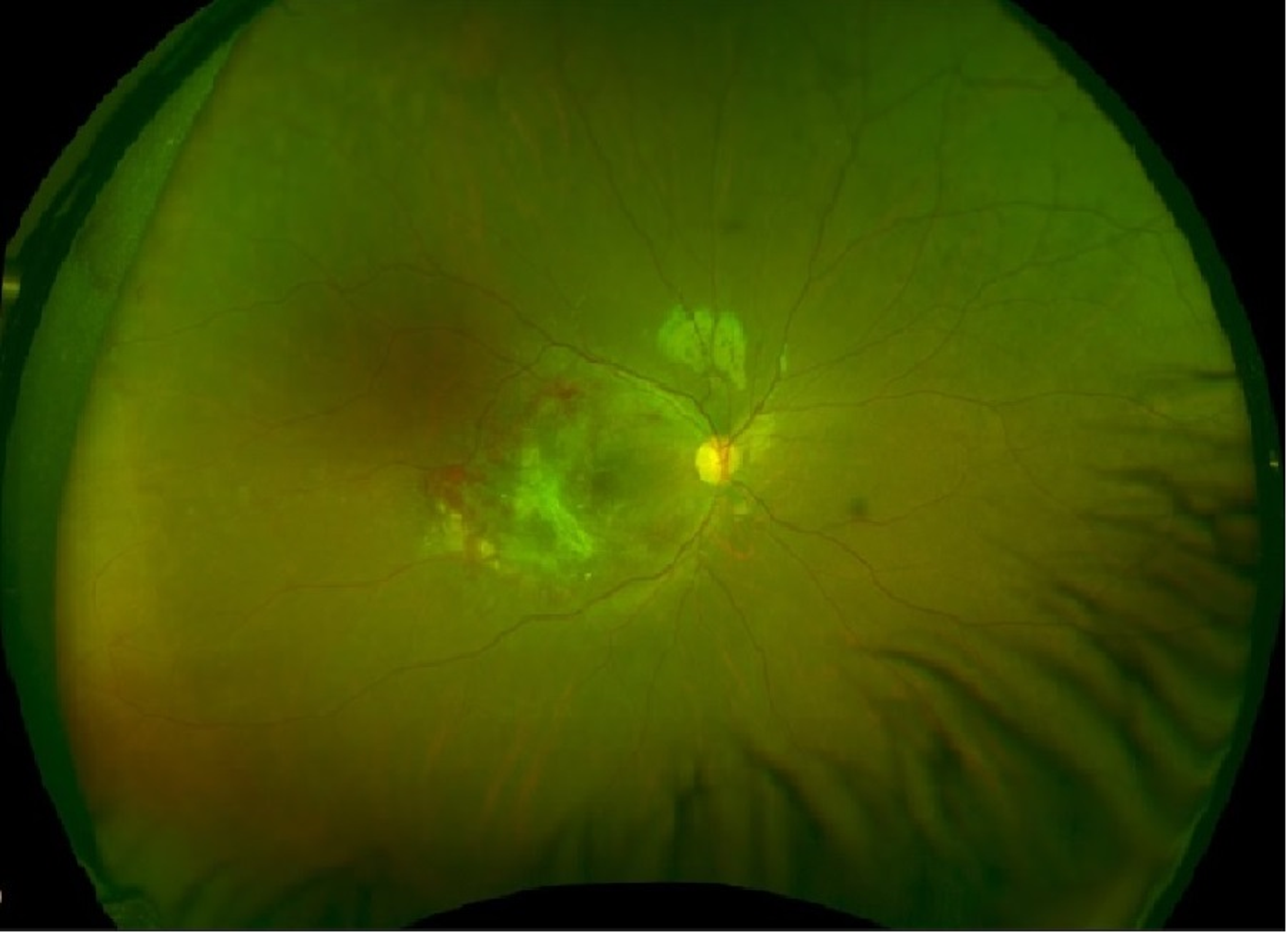 normal retina vs cmv retinitis