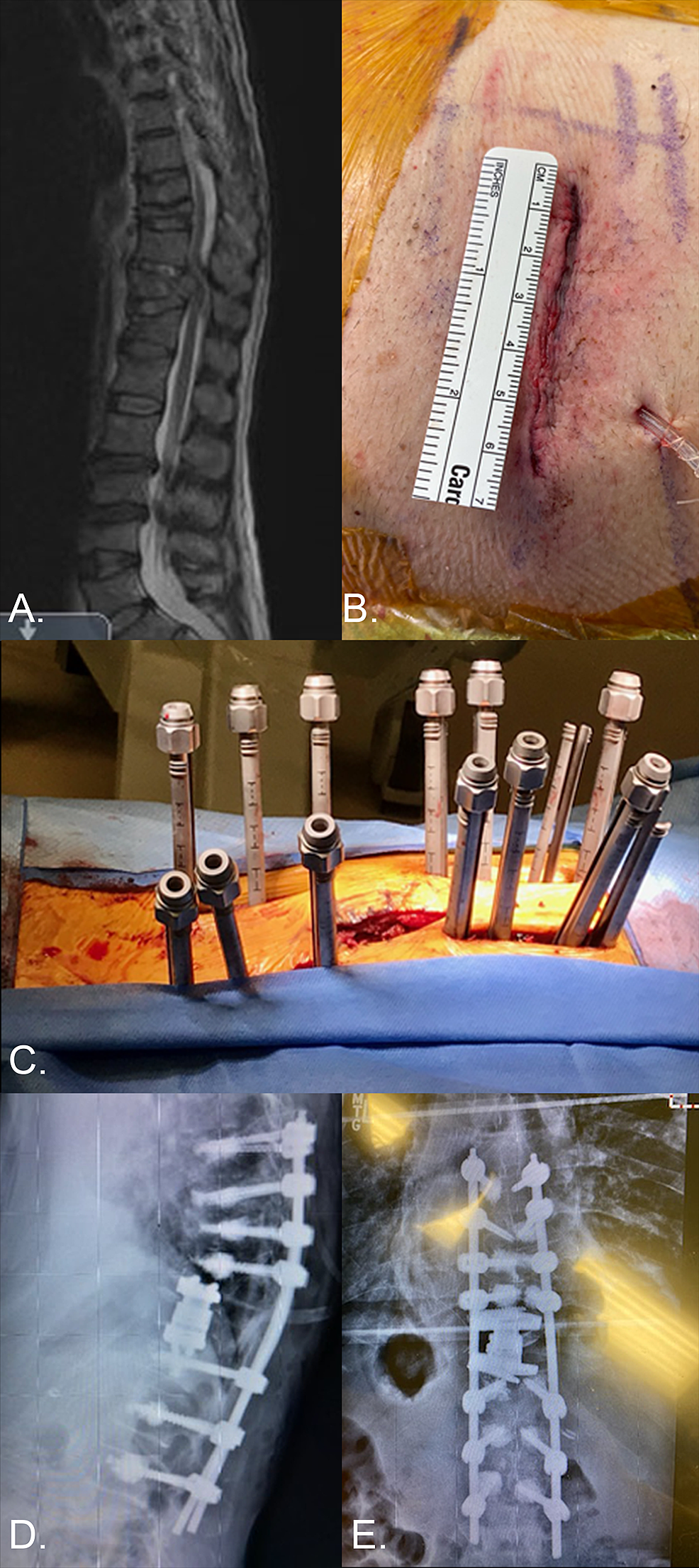 AR-case-by-CAM-employing-the-xvision-platform.-A.-T2W-MRI-demonstrating-T11-pathologic-compression-fracture-resulting-in-severe-spinal-canal-compression,-as-well-as-multiple-chronic-compression-fractures-in-a-58-year-old-myelopathic-male-with-history-of-lung-cancer-and-severe-osteoporosis-(T-score:-2.8).-B.-Stage-1-mini-open-retropleural-thoracotomy-for-T11-corpectomy.-C,D,E:-Stage-2-percutaneous-cement-augmented-T7---L2-pedicle-screw-and-rod-fixation.-Case-highlights-the-utility-of-AR-applications-in-executing-technically-demanding-MIS-applications.-In-this-case,-the-precise-insertion-of-thoracolumbar-pedicle-screws-via-AR-permitted-safe-cement-augmentation-without-visceral,-vascular,-canal,-or-foraminal-cement-extravasation.