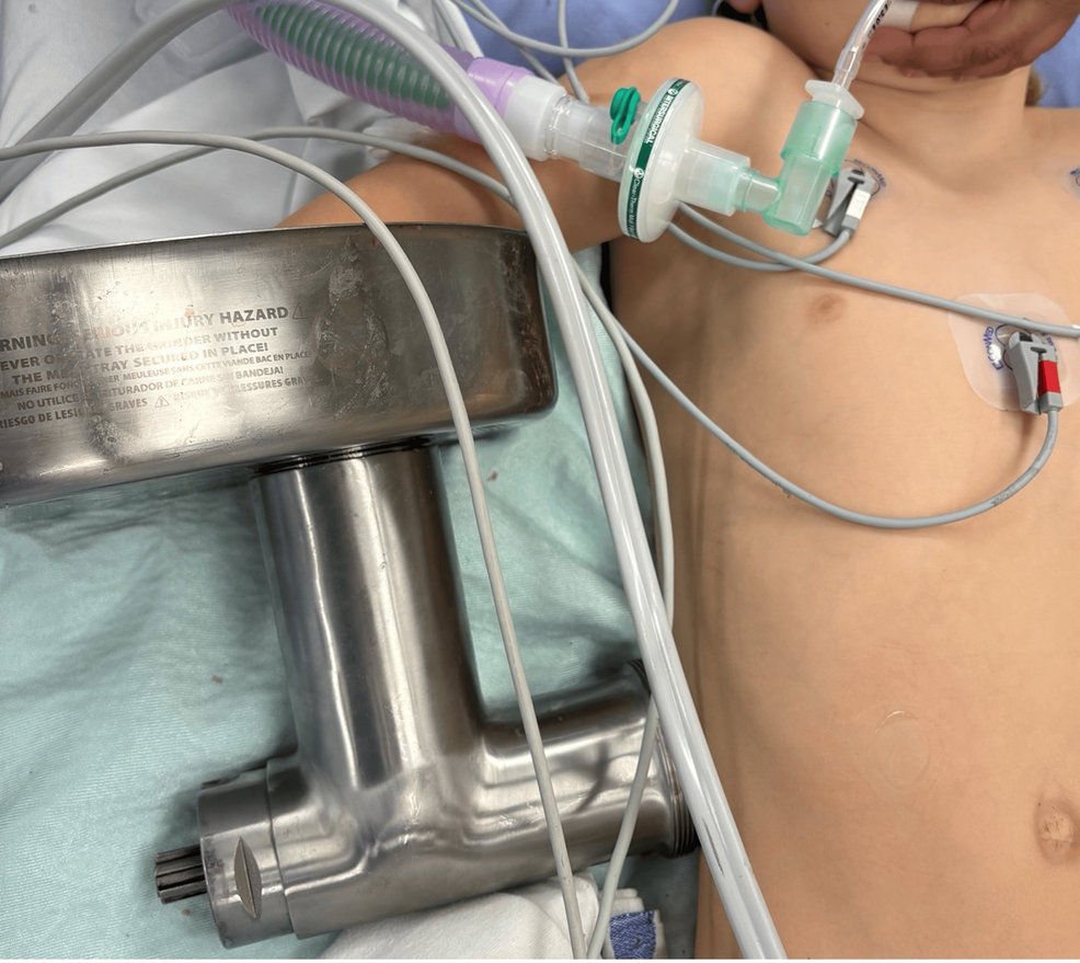 Intraoperative Extrication of a Pediatric Hand Entrapped Within a Household Meat Grinder: A Case Report