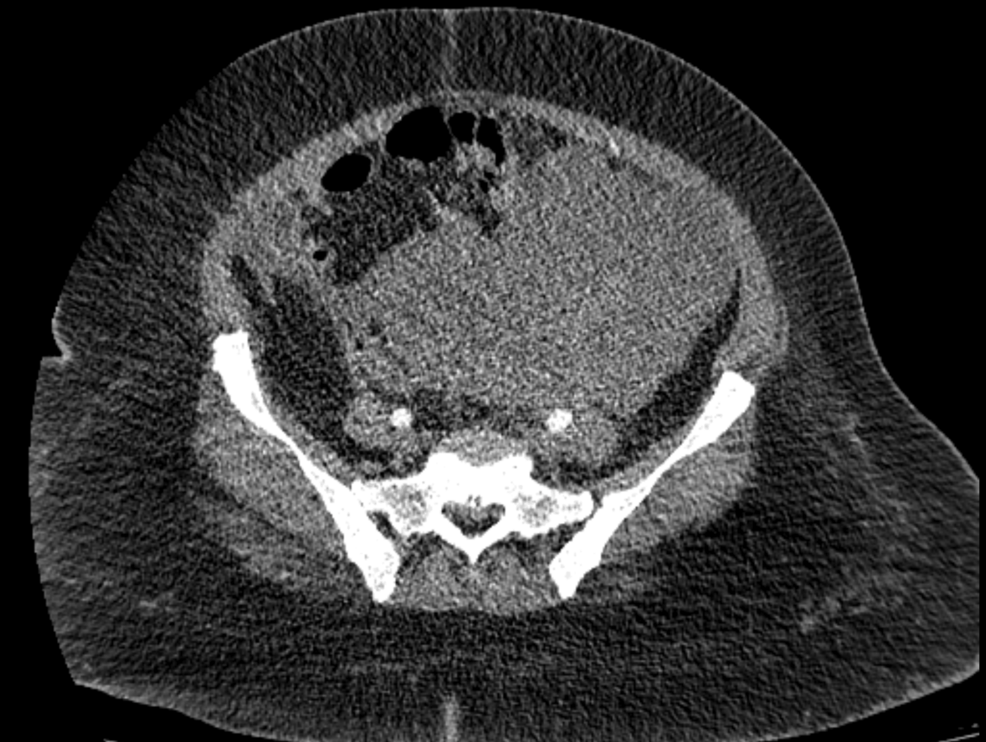 iv glutathione following ct scan Imaging Before and After Treatment with Endocrine Therapy. CT Frontiers | Case report: The