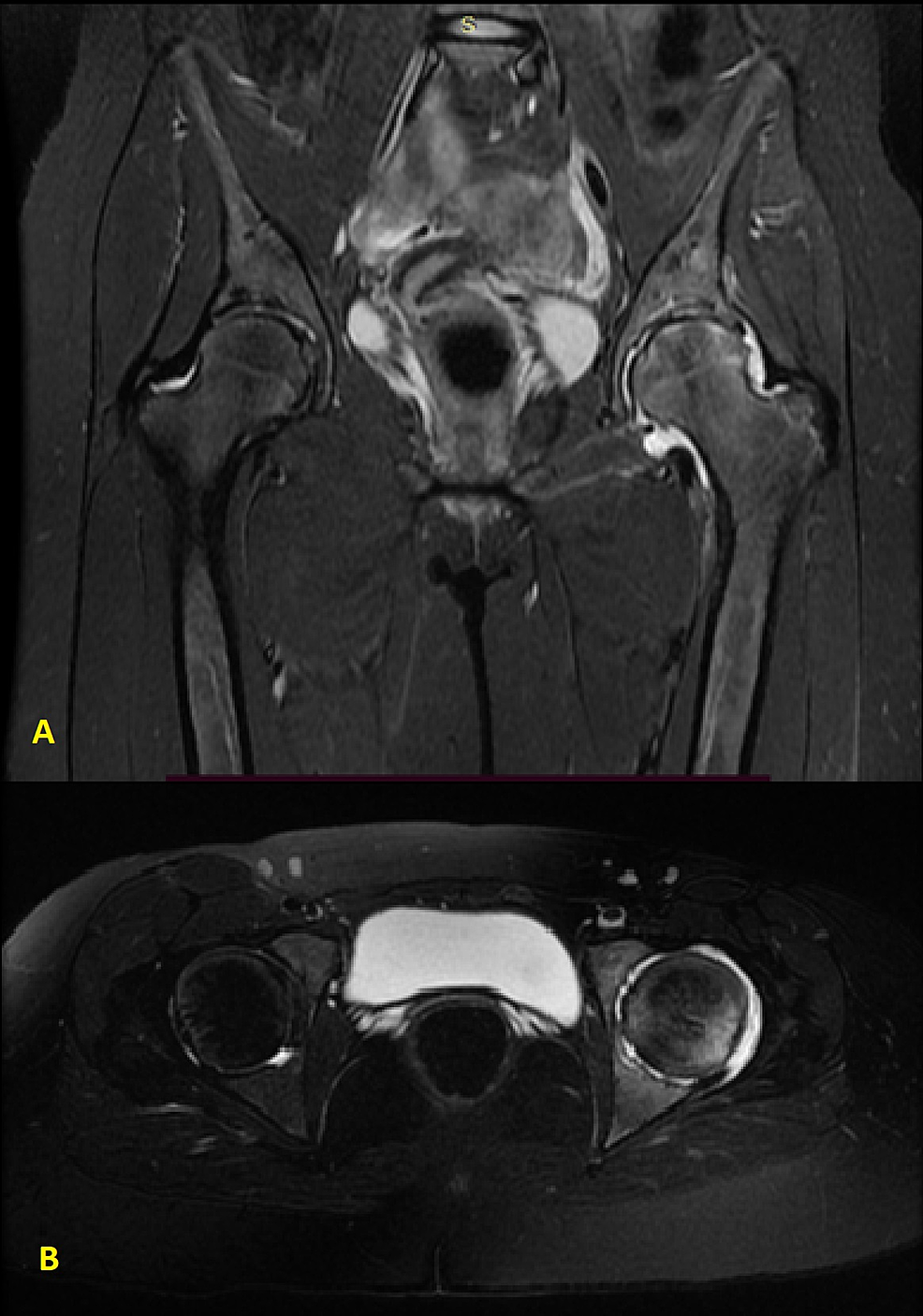 Cureus | Clinical Radiological and Molecular Profile of a Patient ...