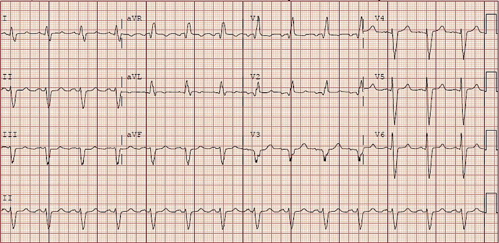 Cureus | Use of Shockwave Lithoplasty for a Patient With Recurrent Angina