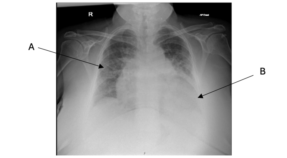 Thyroid Storm at Onset: A Rare Presentation of Graves’ Disease