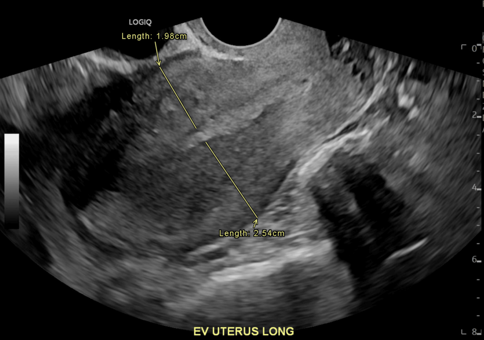 Atypical Polypoid Adenomyofibroma of the Endometrium: Case Report on Severe Uterine Bleeding