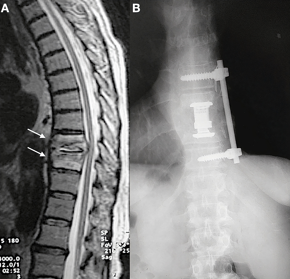 Cureus | Operative Treatment Of Adult Pyogenic Spondylodiscitis: A ...