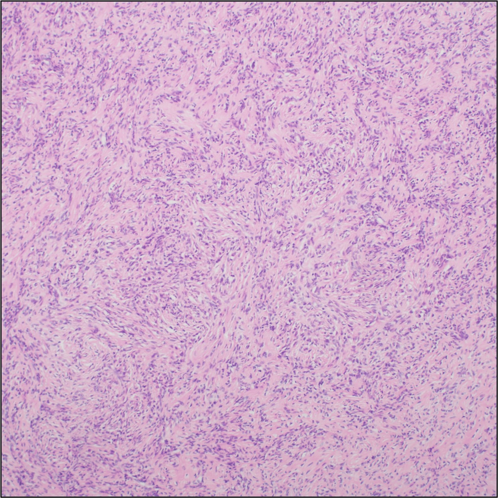 Low-power-image-of-the-lesion-showing-short-fascicles-of-spindle-cells-arranged-in-a-whorled-or-“storiform”-pattern.-The-lack-of-giant-cells-is-consistent-with-the-patient’s-prior-treatment-with-denosumab-(hematoxylin-and-eosin,-100×).