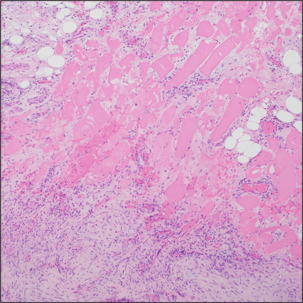 Low-power-image-demonstrating-growth-of-the-lesion-through-native-skeletal-muscle-(arrow)-and-fibroadipose-tissue-(arrowhead)-(hematoxylin-and-eosin,-100×).