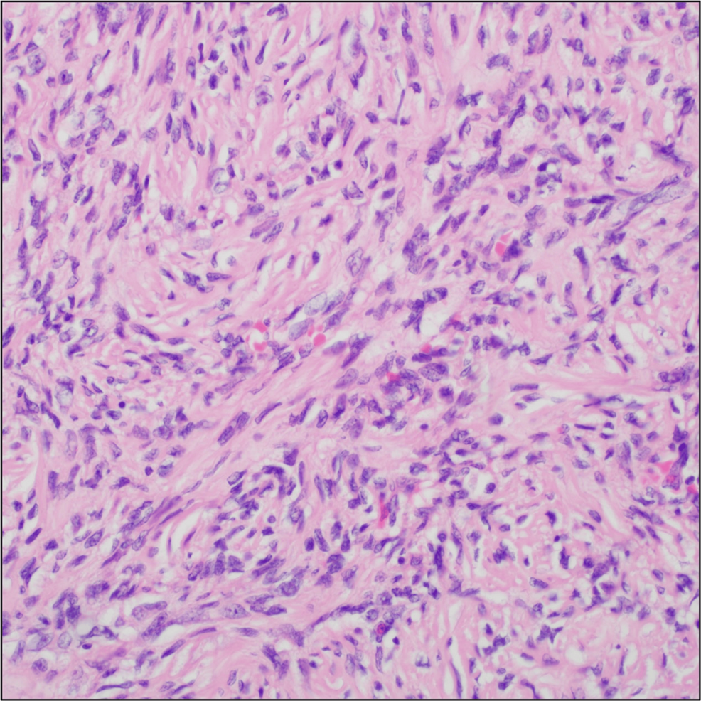 High-power-image-showing-bland-spindled-to-epithelioid-cells-with-minimal-atypia-interspersed-within-a-fibrotic-and-vascular-background-(hematoxylin-and-eosin,-400×).