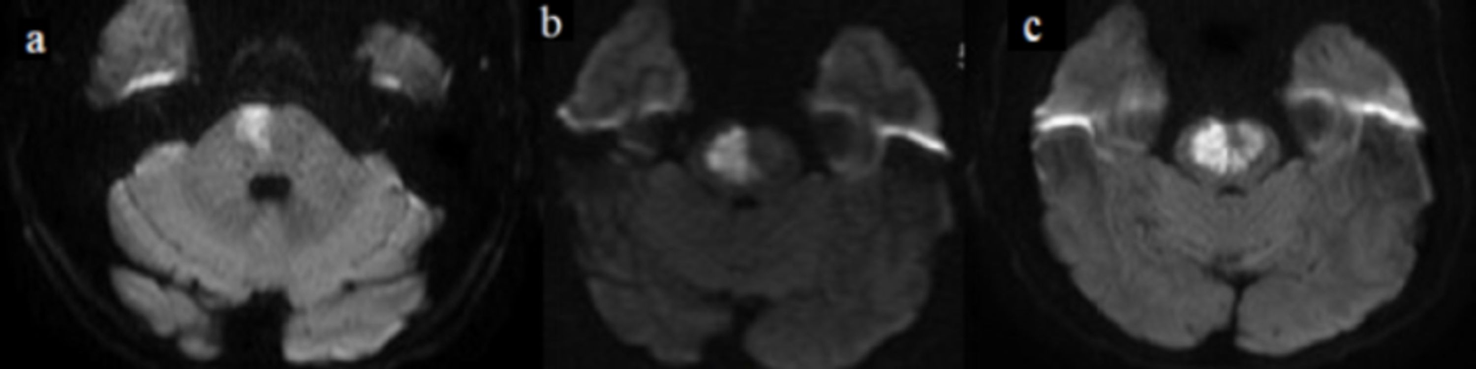 lateral pontine syndrome mri