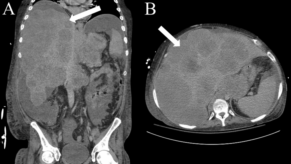 Spontaneous Tumor Lysis Syndrome in Refractory Metastatic Esophageal Adenocarcinoma Presenting With Septic Shock