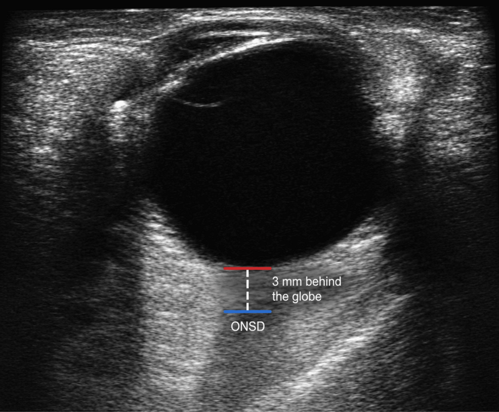 Optic-nerve-sheath-diameter-(ONSD)-measured-by-a-linear-ultrasound-probe-